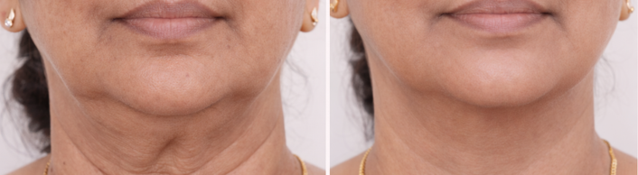 Lifted jawline result